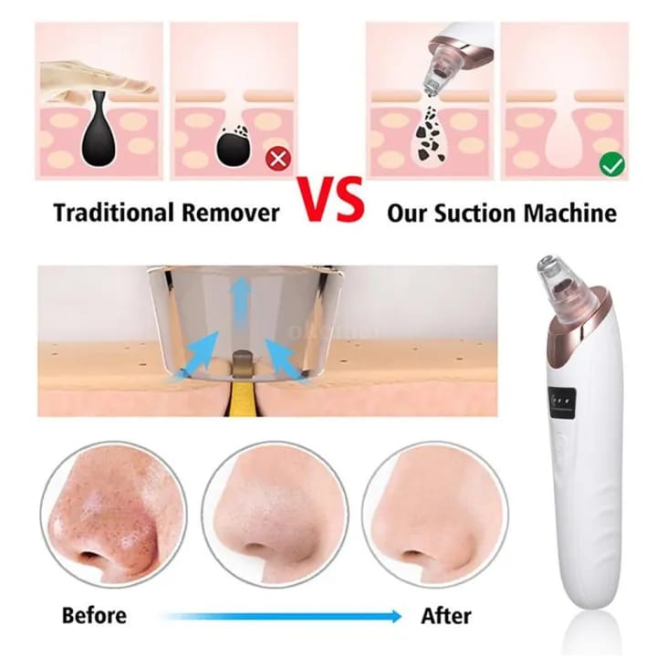 Blackhead Remover – Deep Cleanser for Glowing Skin